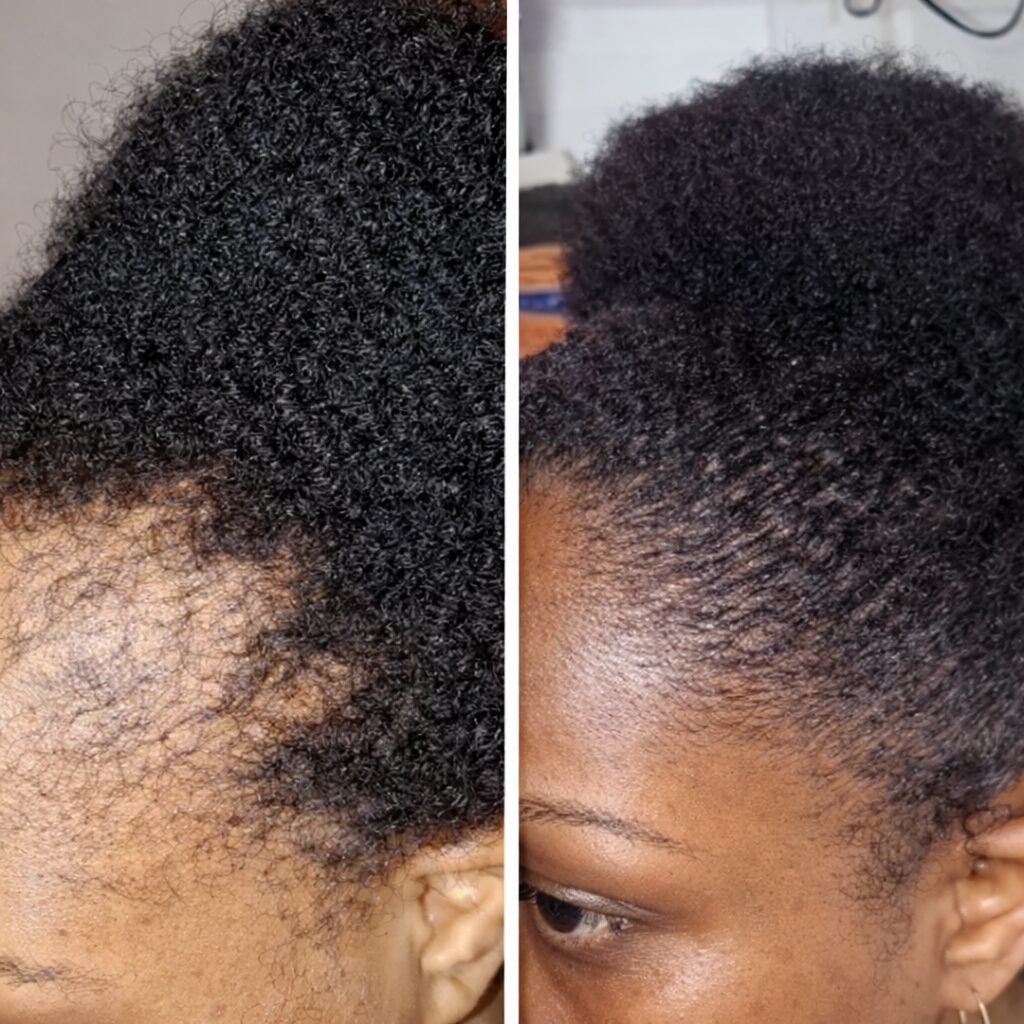 Avant après ligne de cheveux et tempes - Envihair